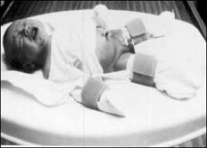 Medievil circumstraint devices are used to hold the objecting baby down